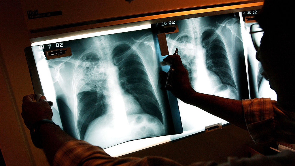 2 active tuberculosis cases traced to San Francisco strip club — KTVU FOX 2 Bay Area, San Ramon Health news